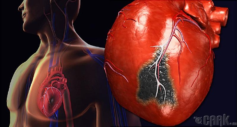Зүрхний шигдээс өвчин гэж юу вэ?