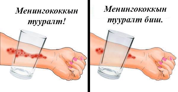 Менингококкын халдварын шинж тэмдгийг хэрхэн таних вэ