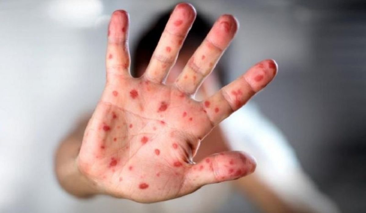 Улаанбурхан өвчний 9 тохиолдол бүртгэгдлээ