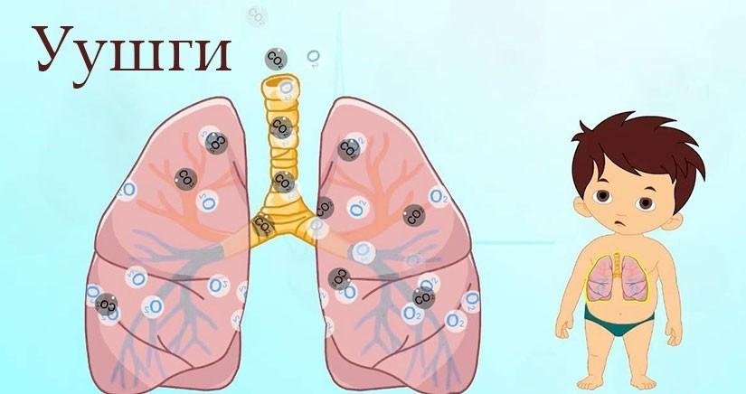 Хатгалгаа өвчний шинж тэмдгийг таних, урьдчилан сэргийлэх аргууд