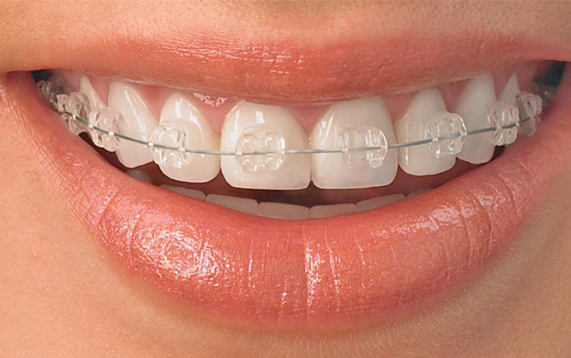 Шүдний гажиг засал гэж юу вэ?