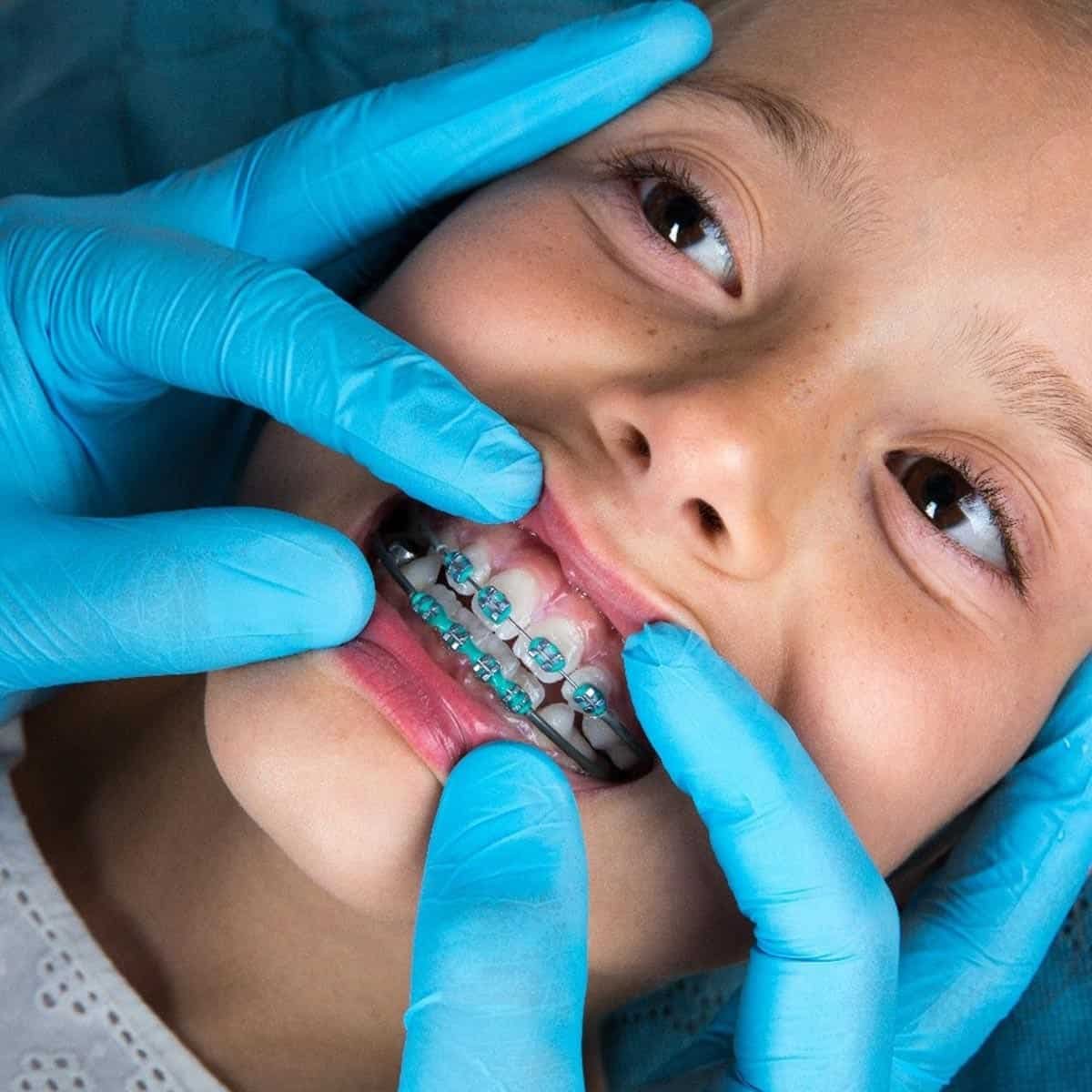 Хэдэн насанд шүдний гажиг заслын аппарат зүүхэд хамгийн тохиромжтой вэ?
