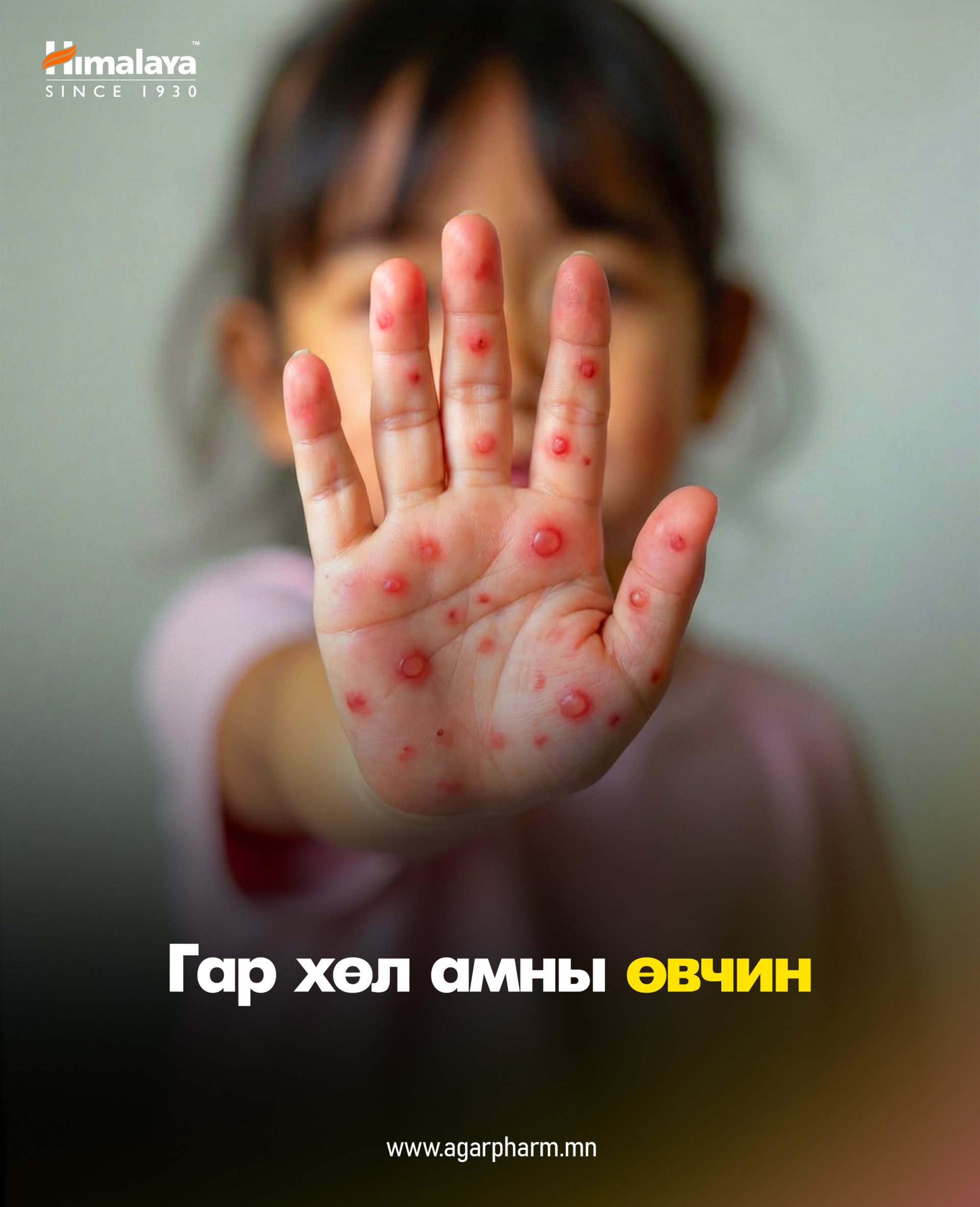 Гар хөл амны өвчин гэж юу вэ? 