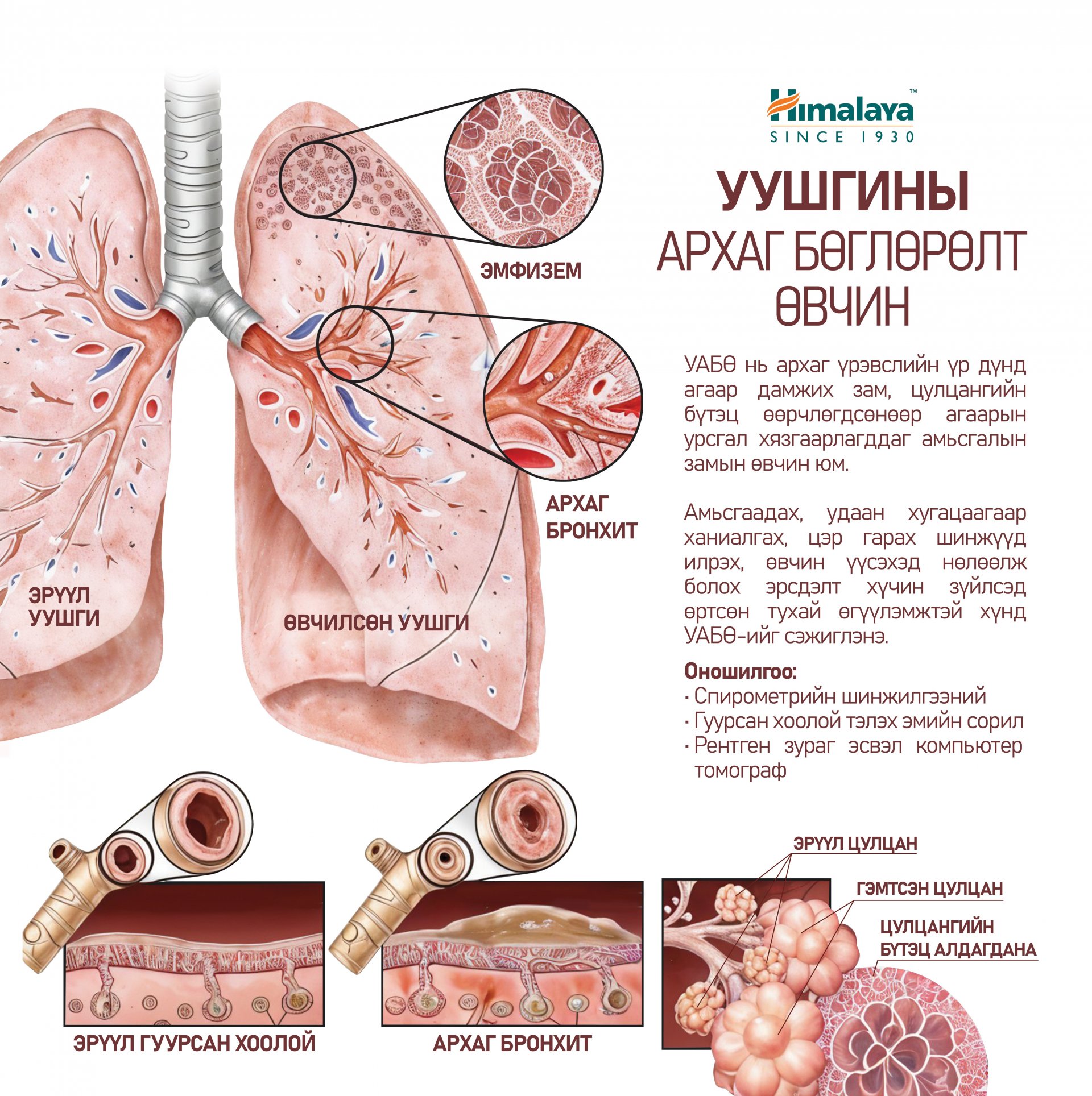 Шатаар өгсөхөд амьсгал давчдах, амьсгаадах нь уушгины архаг бөглөрөлт өвчний шинж