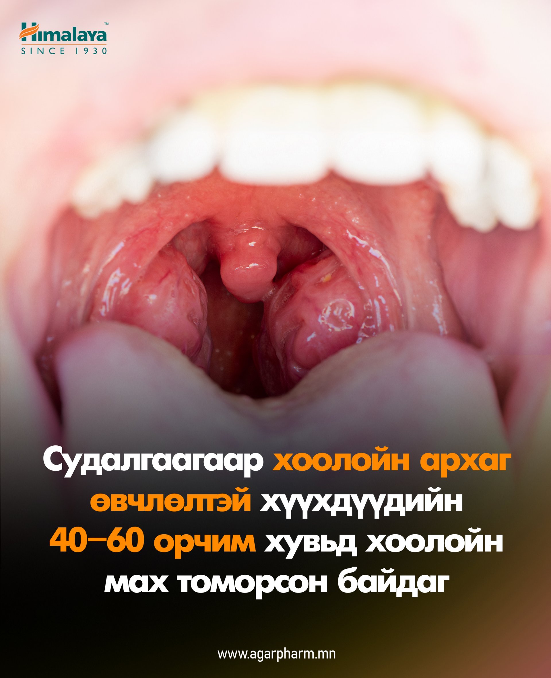 Гүйлсэн булчирхай яагаад томордог вэ?