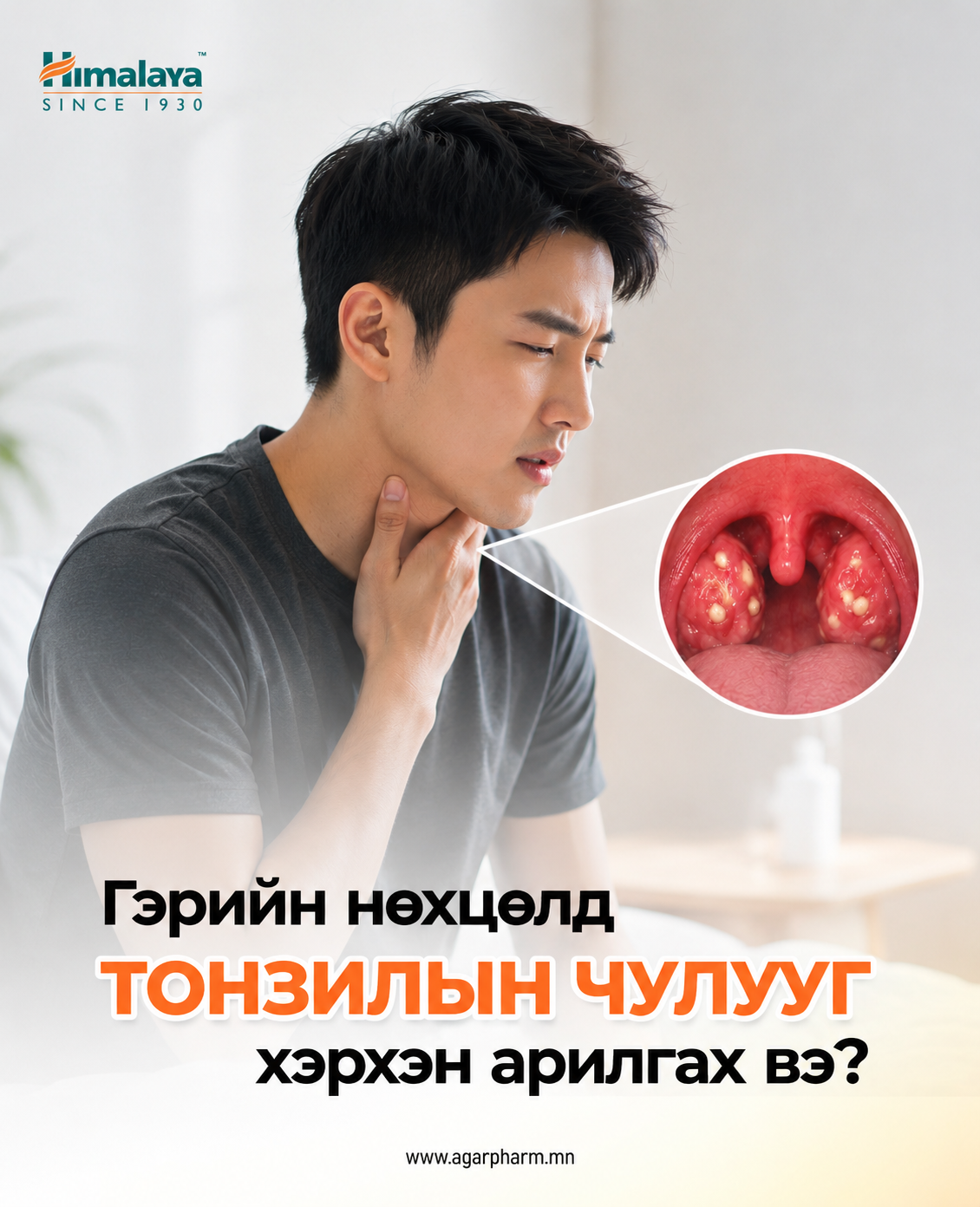Гэрийн нөхцөлд тонзилын чулууг хэрхэн арилгах вэ?