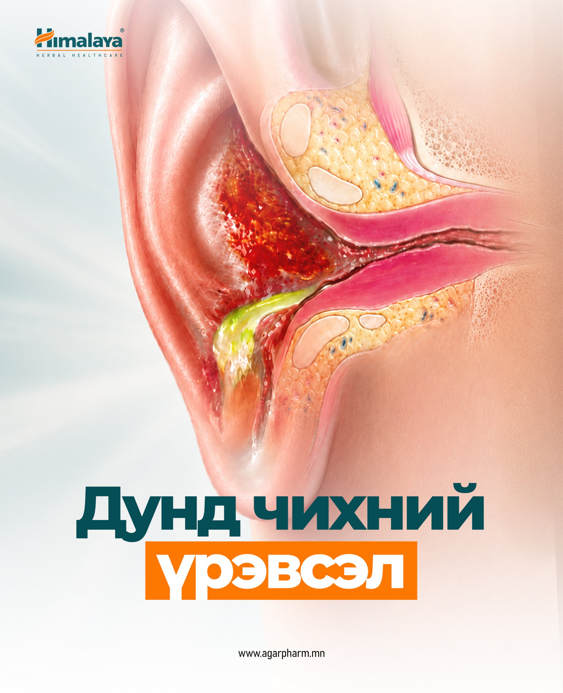Дунд чихний үрэвсэл: Шинж тэмдэг, шалтгаан, эмчилгээ, урьдчилан сэргийлэлт  